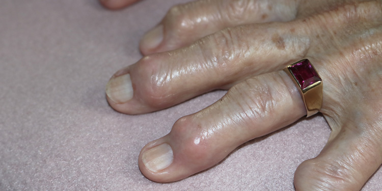 Finger mit Gicht